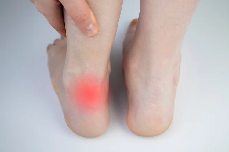 Close-up of inflamed heel showing Achilles tendonitis symptoms.
