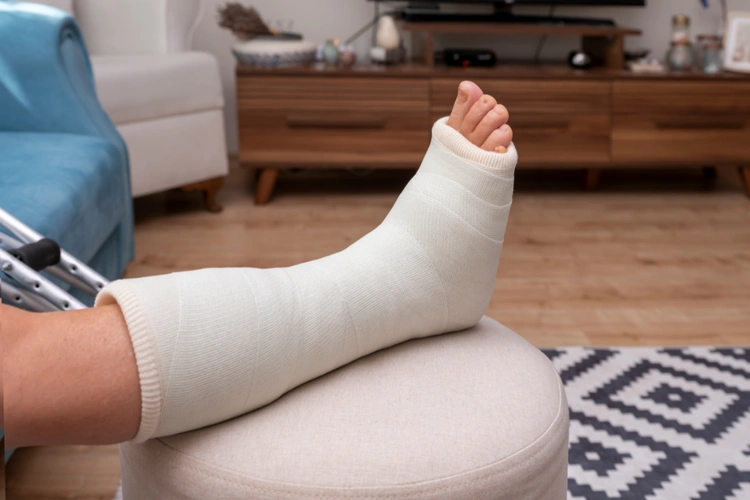 Leg in ankle cast resting on stool showing immobilisation and recovery after a broken ankle fracture.