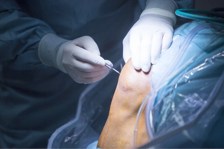 Surgeon performing arthroscopic ACL reconstruction surgery in Singapore using minimally invasive technique.