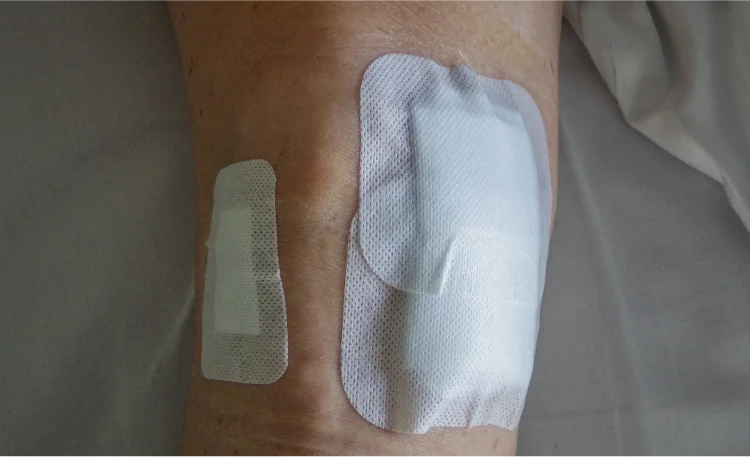 Bandaged knee after arthroscopic surgery with small incisions.