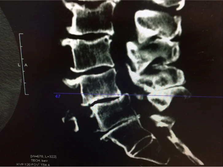 Sagittal CT scan showing lumbar spine fractures and degeneration.