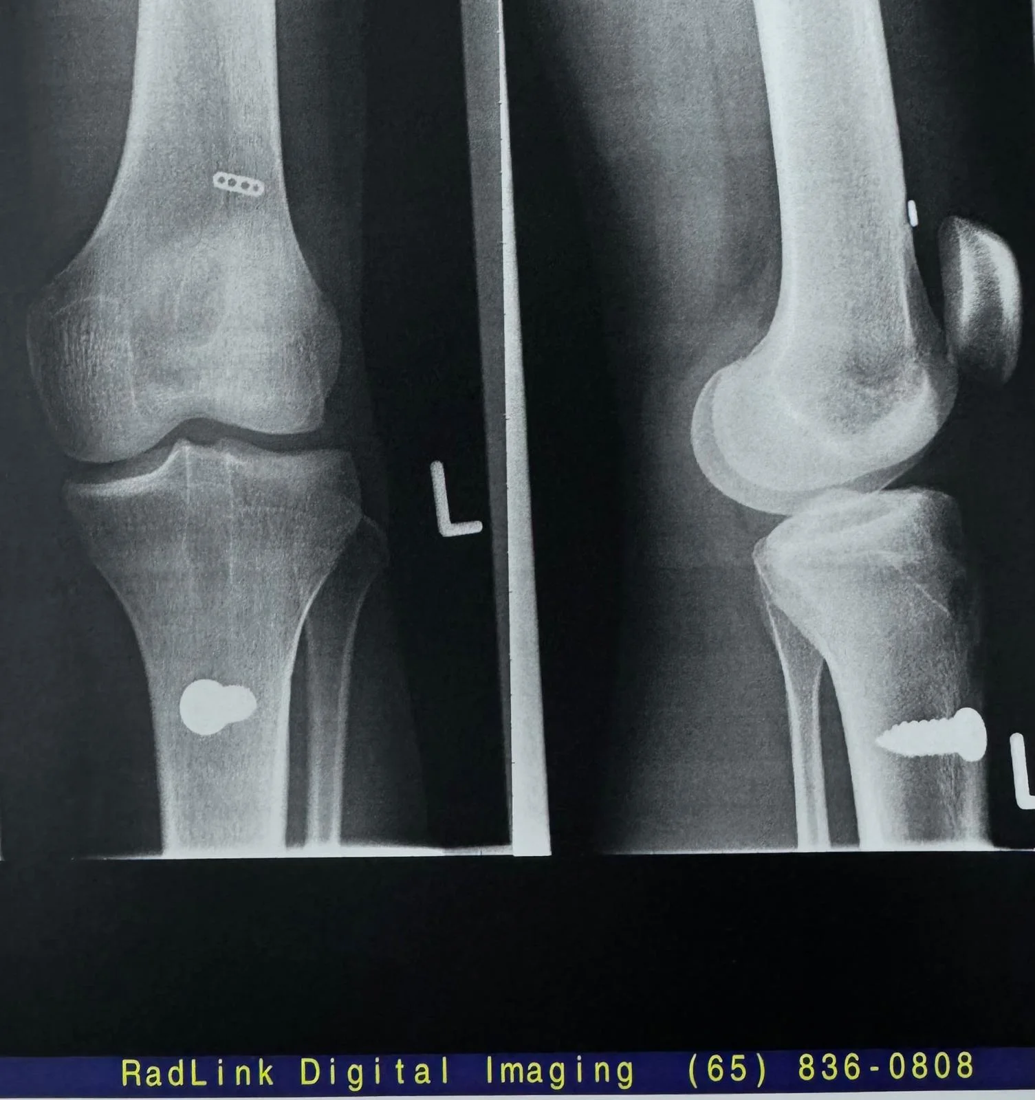Dr Foo's knee X-ray after ACL reconstruction surgery