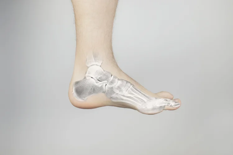 Foot illustration with calcaneus bone highlighted which can be prone to heel sports injuries.