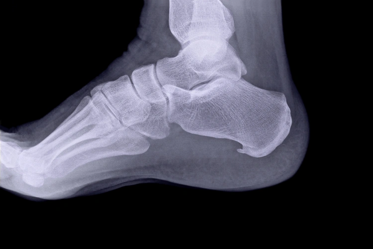 Lateral foot X-ray showing heel spur formation under the heel bone associated with plantar strain.