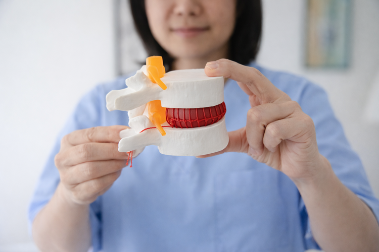 Specialist holding spine model showing herniated disc compressing a nerve.