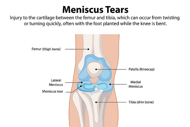 Medical illustration of knee joint showing meniscus anatomy, tear sites, and function.