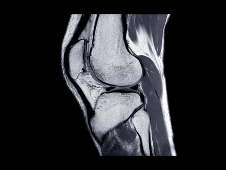 MRI scan of knee joint used for diagnosis.