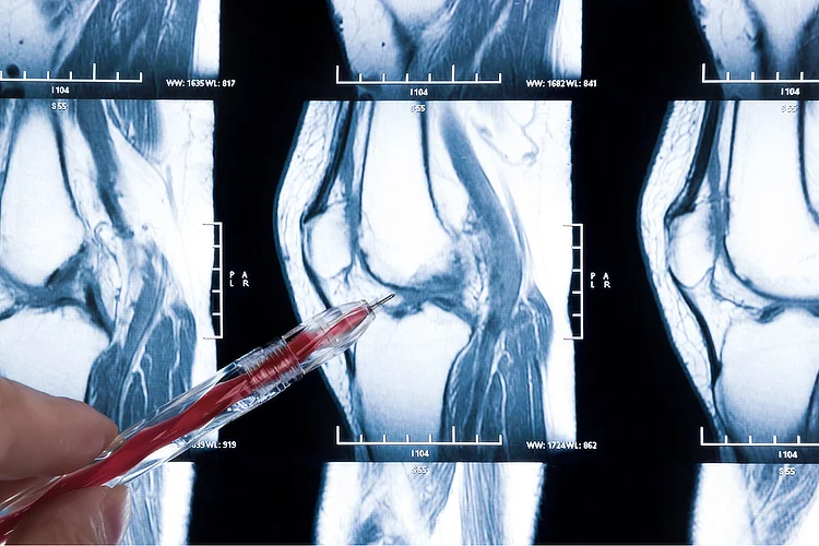 MRI scan of knee showing highlighted meniscus tear to assess cartilage damage.
