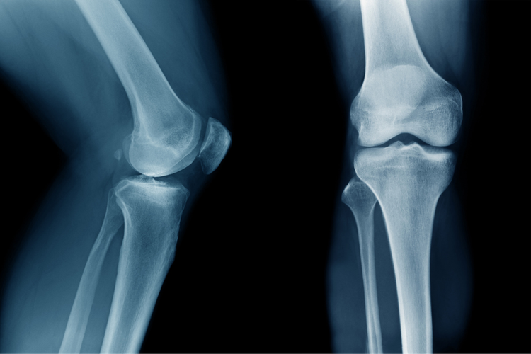 Knee X-ray illustrating imaging used to assess bone alignment and diagnose ski knee injuries.