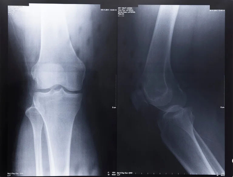 X-ray of osteoarthritic knee showing cartilage loss and bone spurs.