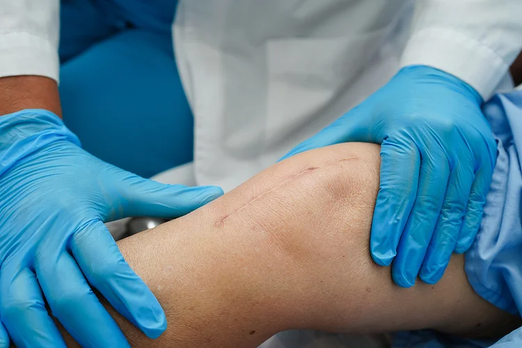 Post-surgical knee showing scar after knee replacement surgery for pain relief and joint function.