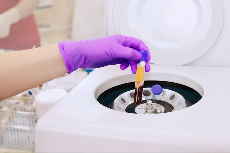 Medical professional holding test tube showing PRP layer after centrifugation.