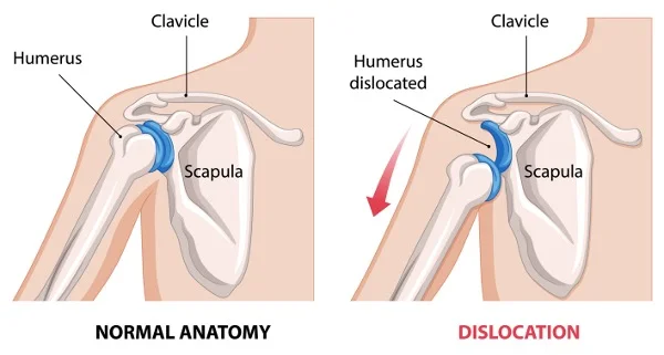 Infographic comparing normal shoulder anatomy with dislocated humerus.