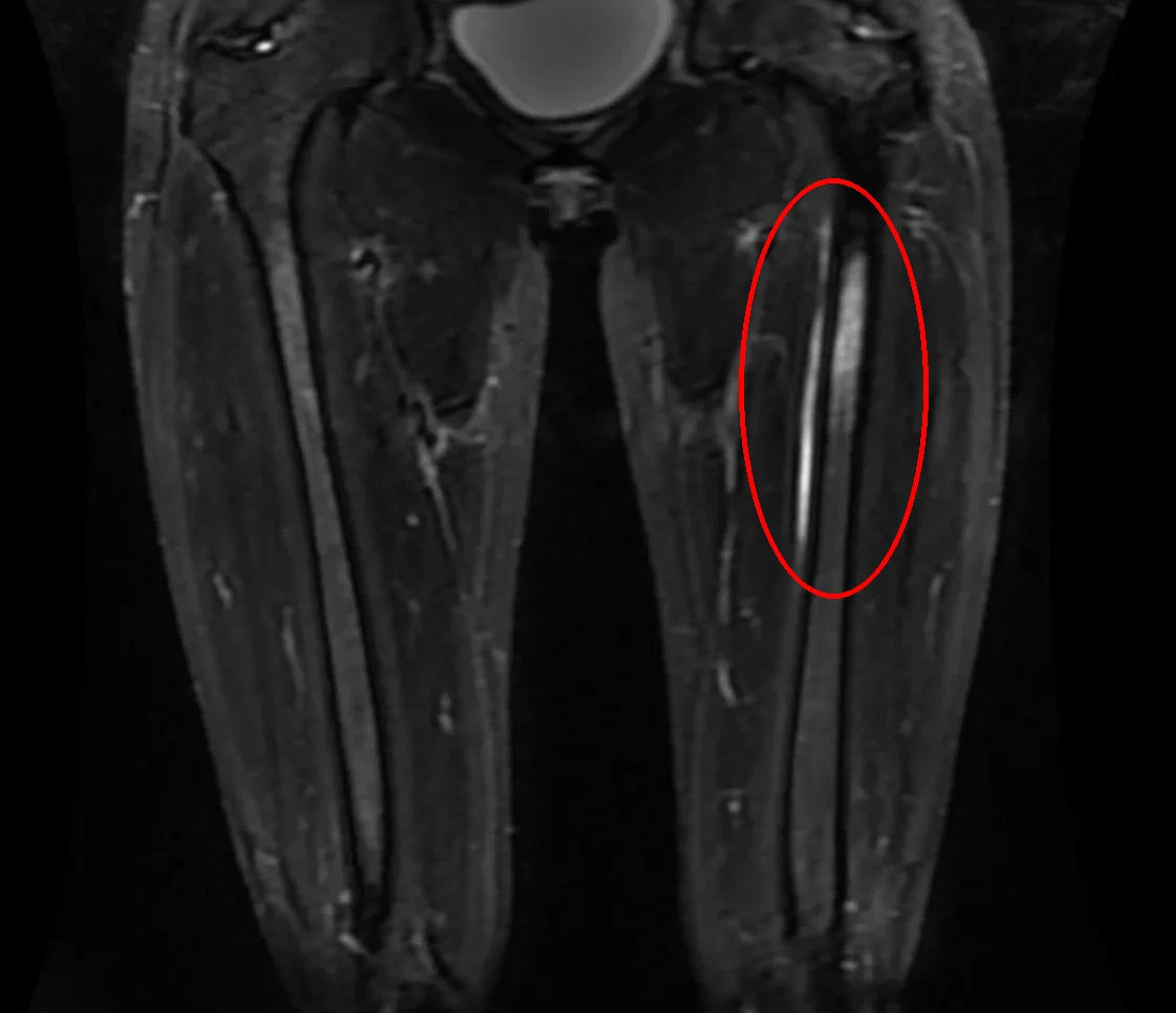 MRI scan of femur showing bone marrow changes in stress fracture