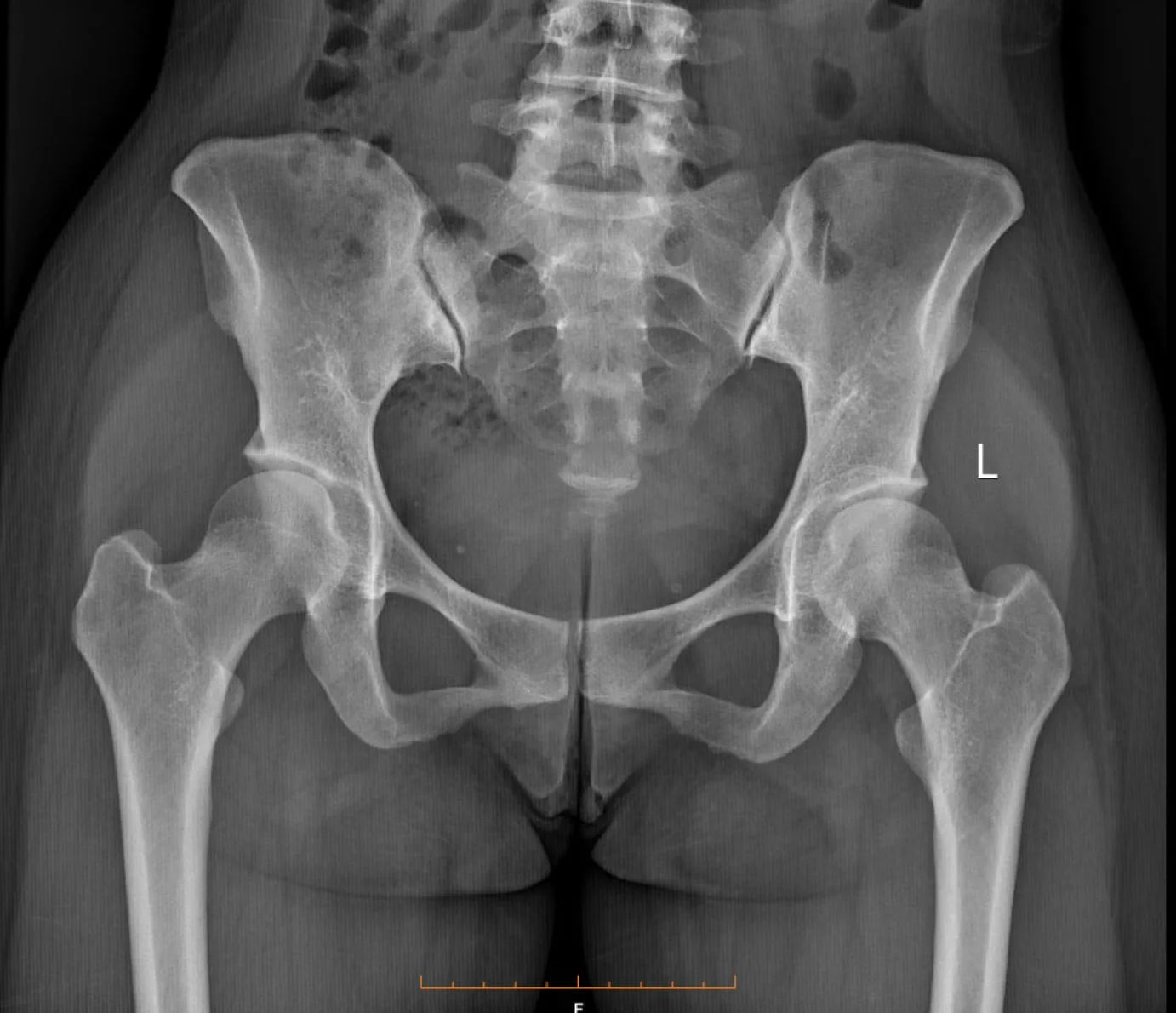 X-ray of pelvis and hip bones used to diagnose stress fractures