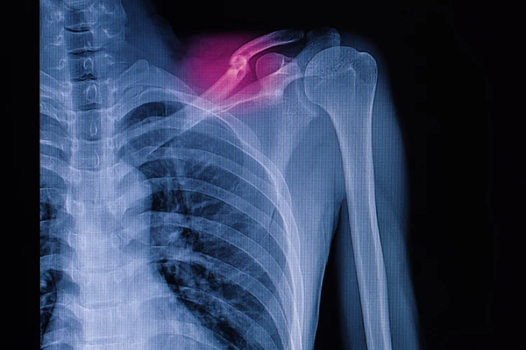 X-ray of collarbone fracture with highlighted break and bone displacement.