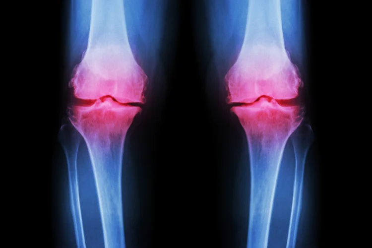 X-ray of knees with highlighted cartilage damage and inflammation from osteoarthritis.